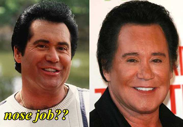 Wayne Newton Plastic Surgery: Facelift, Botox, Eyelid Surgery