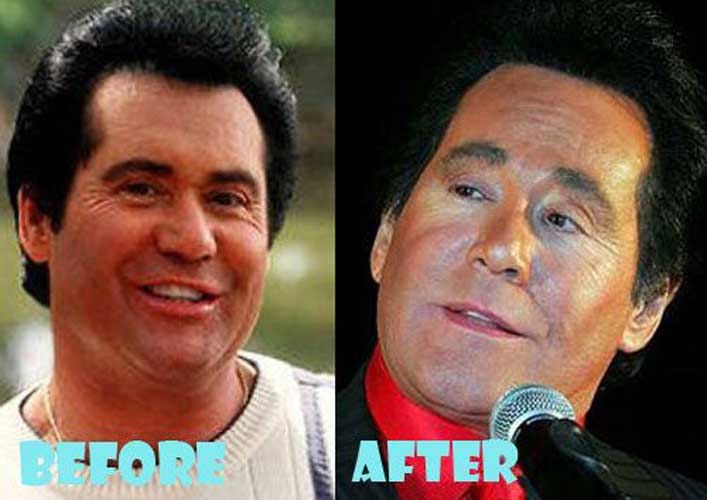 Wayne Newton Plastic Surgery: Facelift, Botox, Eyelid Surgery