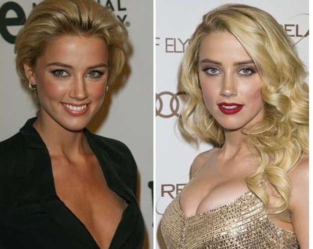 Amber Heard Plastic Surgery