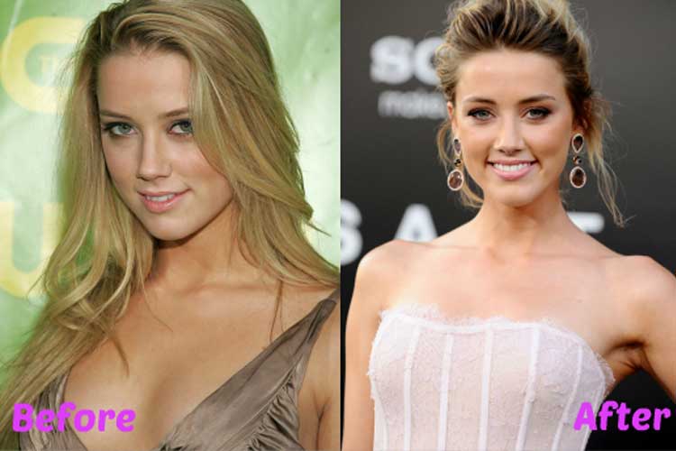 Amber Heard Plastic Surgery