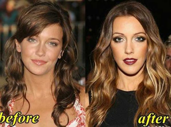 Katie Cassidy Plastic Surgery: Cheek improves, Rhinoplasty, Chin implants