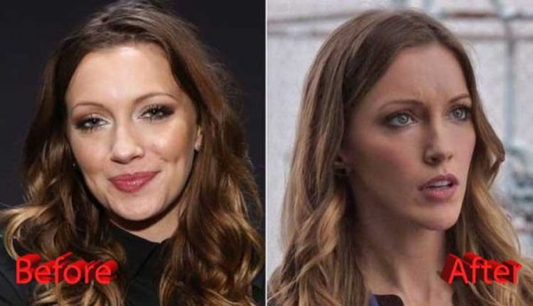 Katie Cassidy Plastic Surgery: Cheek improves, Rhinoplasty, Chin implants