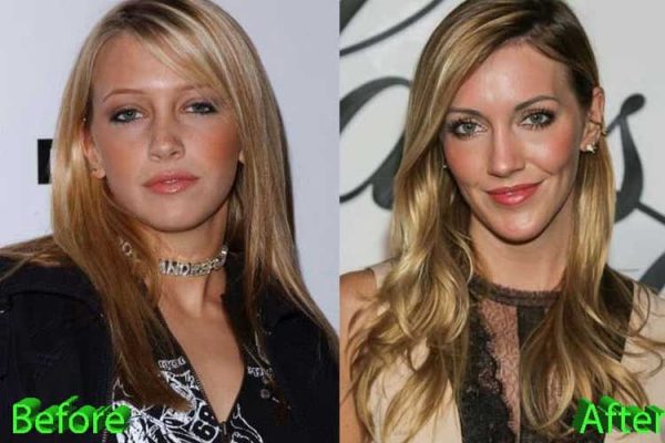 Katie Cassidy Plastic Surgery: Cheek improves, Rhinoplasty, Chin implants