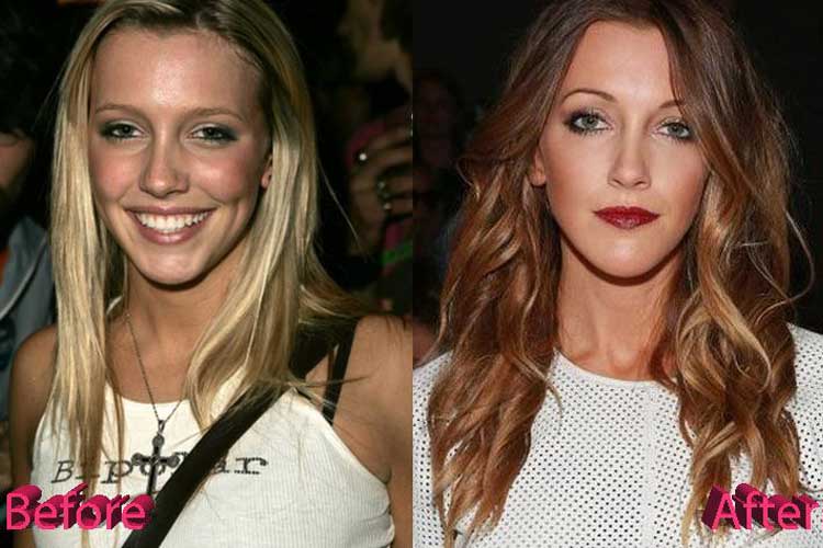 Katie Cassidy plastic surgery