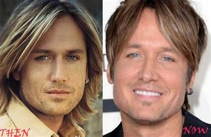 Keith Urban Botox