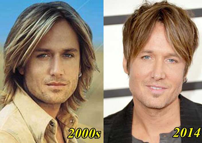 Keith Urban plastic surgery