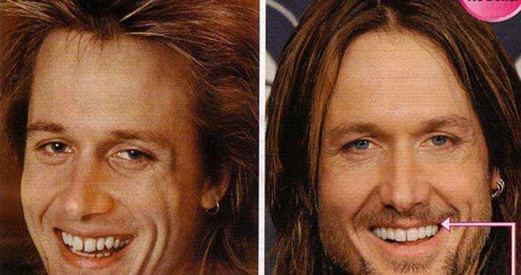 Keith Urban plastic surgery