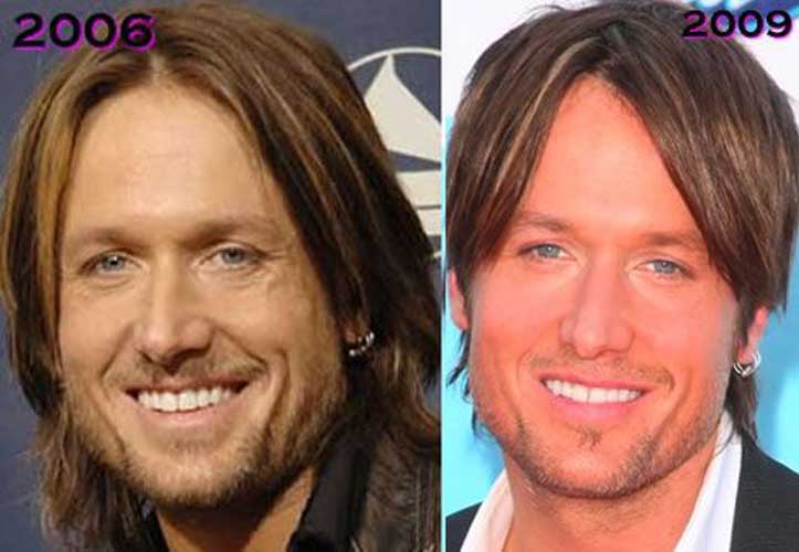 Keith Urban plastic surgery