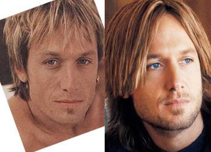 Keith Urban plastic surgery