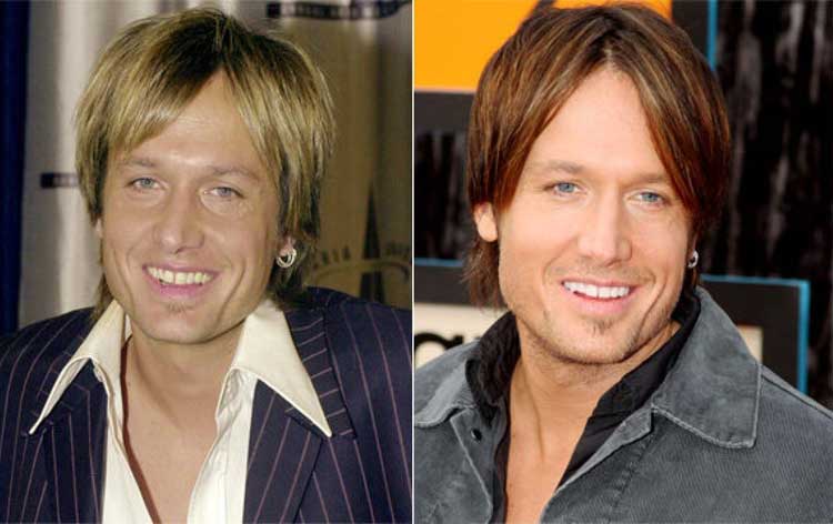 Keith Urban plastic surgery 