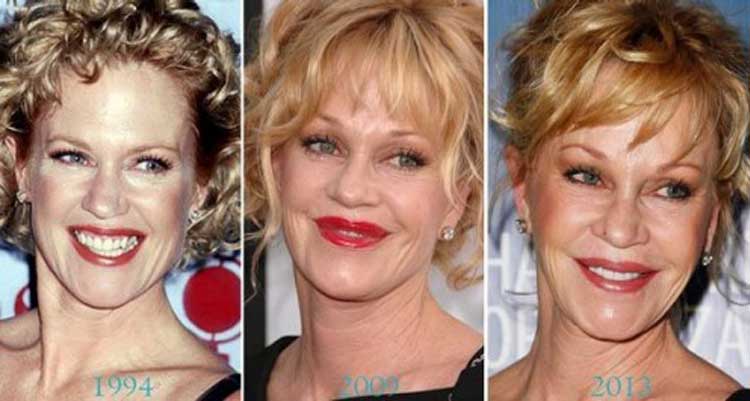 Melanie Griffith plastic surgery