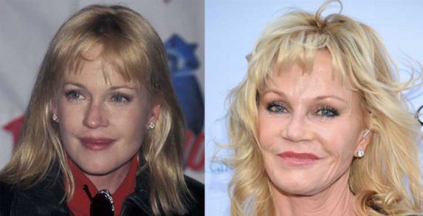 Melanie Griffith Plastic Surgery: Lip Augmentation, Facelift, Botox