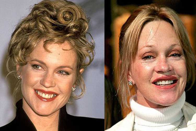 Melanie Griffith plastic surgery