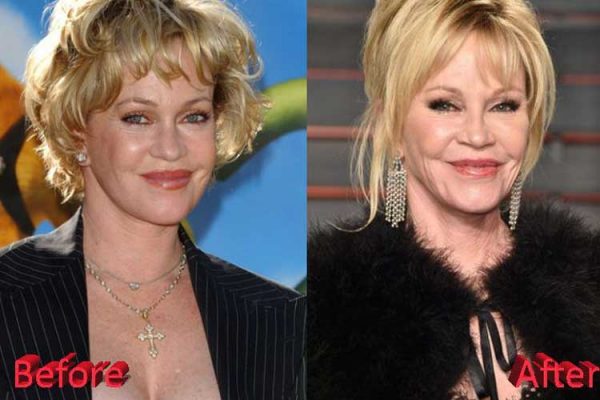 Melanie Griffith Plastic Surgery: Lip Augmentation, Facelift, Botox