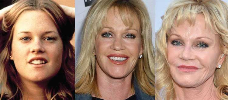 Melanie Griffith plastic surgery