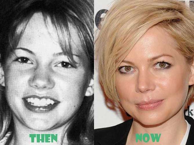 Michelle Williams plastic surgery