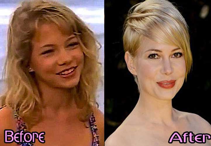 Michelle Williams plastic surgery