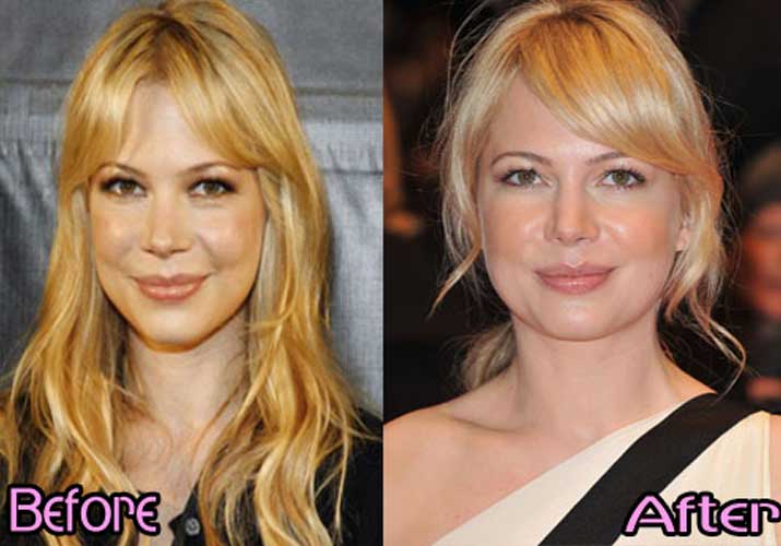 Michelle Williams plastic surgery