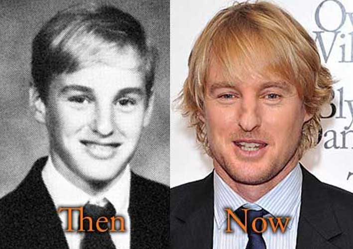 Owen Wilson Nose Job