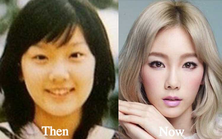 Taeyeon plastic surgery