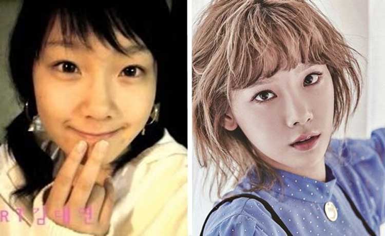 Taeyeon plastic surgery