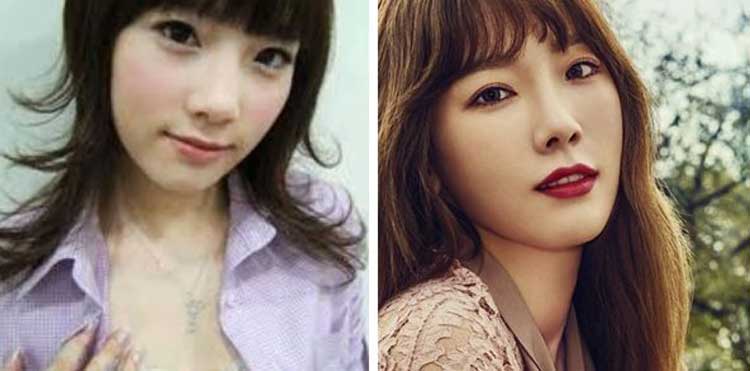 Taeyeon plastic surgery