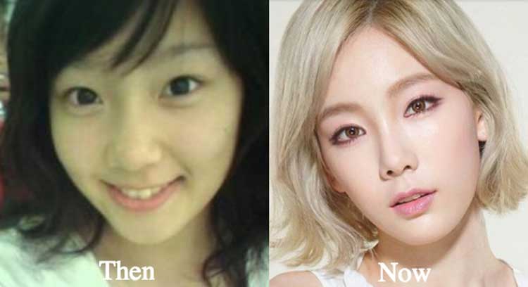 Taeyeon plastic surgery