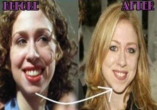 Chelsea Clinton plastic surgery