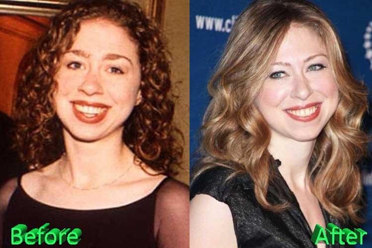 Chelsea Clinton Plastic Surgery: Nose Job, Chin Implant ...