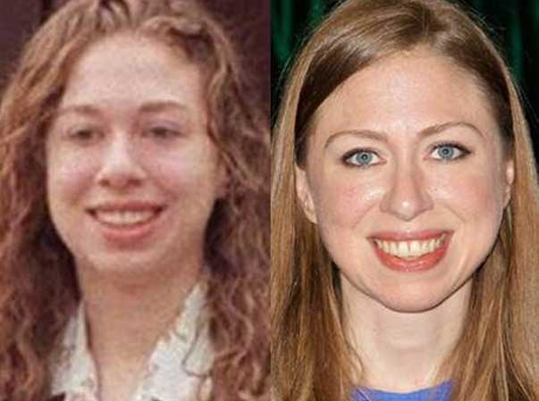 Chelsea Clinton plastic surgery