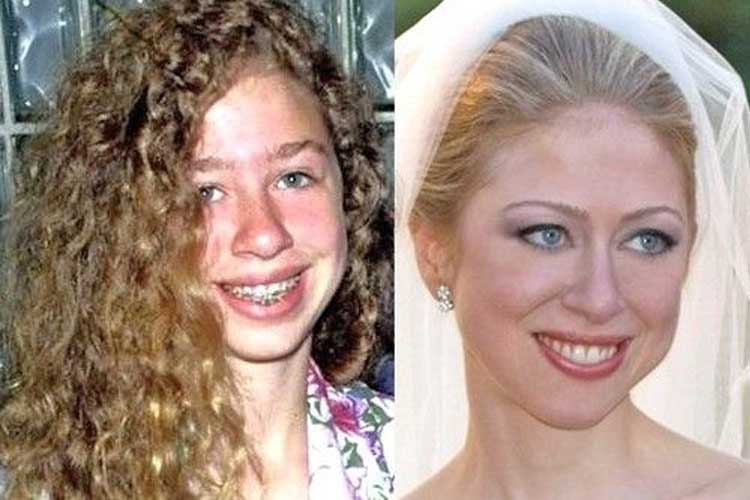 Chelsea Clinton plastic surgery