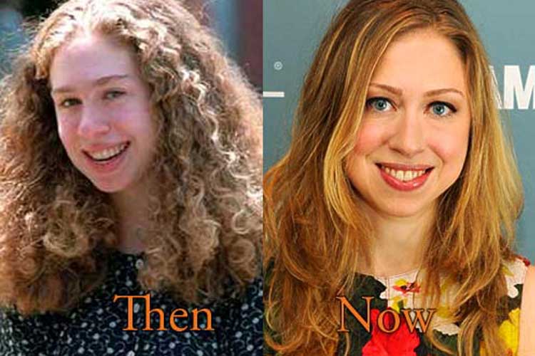 Chelsea Clinton plastic surgery