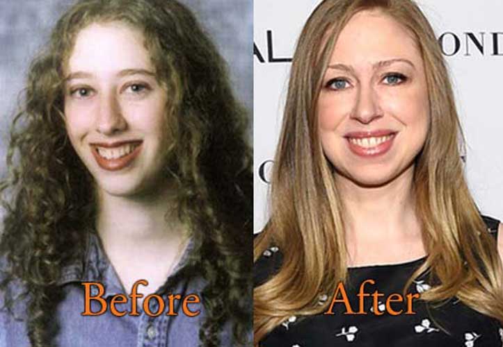 Chelsea Clinton plastic surgery