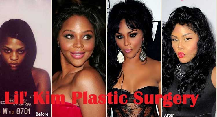 Lil Kim plastic surgery 