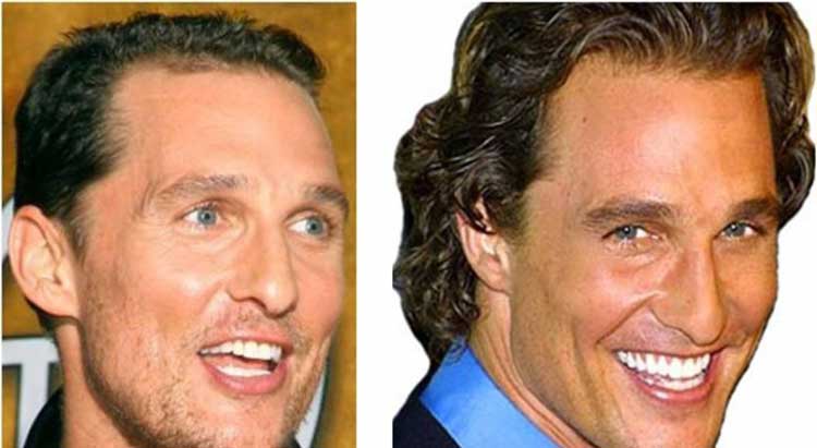 Matthew Mcconaughey plastic surgery