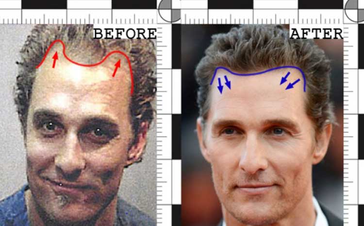 Matthew Mcconaughey Plastic Surgery Nose Job Facelift Baldness 