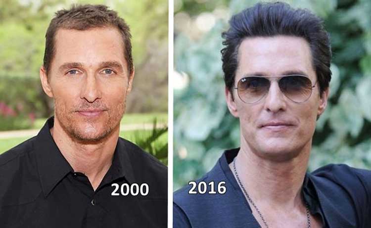 Matthew Mcconaughey plastic surgery