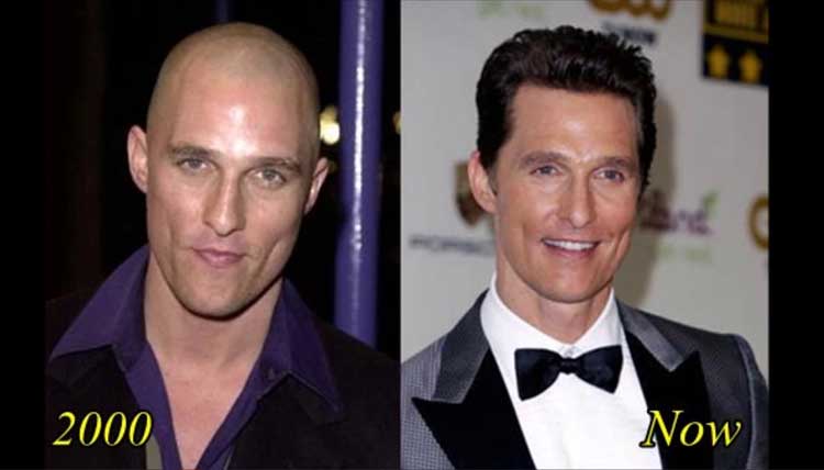 Matthew Mcconaughey plastic surgery