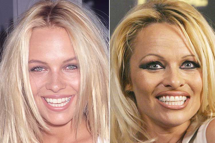 Pamela Anderson Plastic Surgery: Lip Filler, Nose Job, After and Before