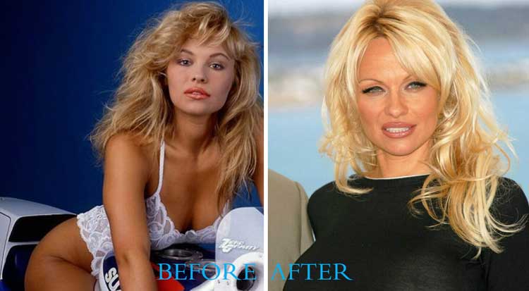 Pamela Anderson Plastic Surgery 