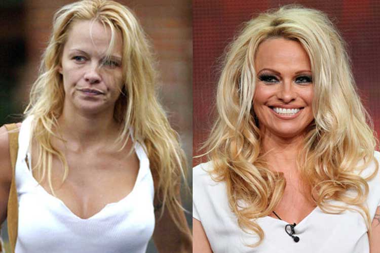 Pamela Anderson Plastic Surgery Lip Filler Nose Job After And Before 