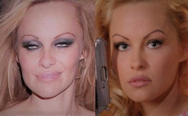 Pamela Anderson Plastic Surgery Lip Filler Nose Job After And Before 