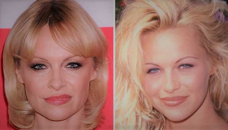 Pamela Anderson Plastic Surgery Before And After Pict 