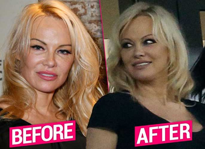 Pamela Anderson Plastic Surgery 