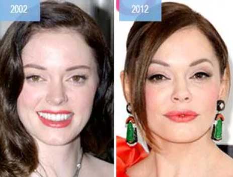 Rose McGowan Plastic Surgery 