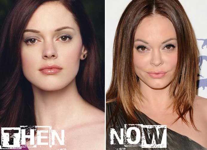 Rose McGowan Plastic Surgery 