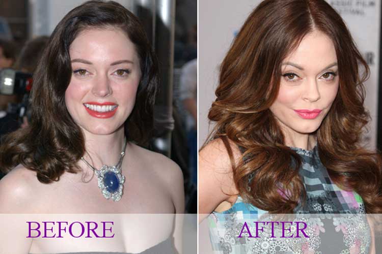 Rose McGowan Plastic Surgery 