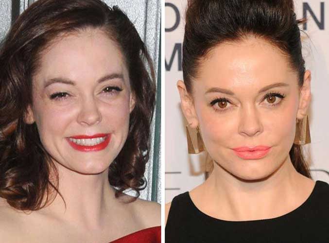 Rose McGowan Plastic Surgery 