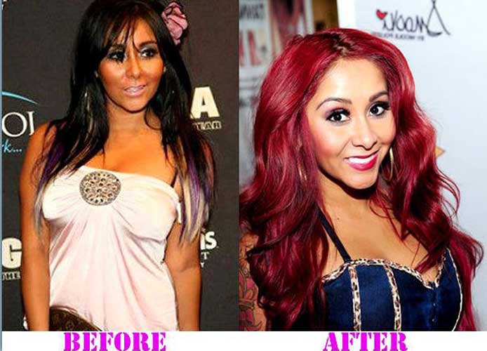 Snooki Plastic Surgery