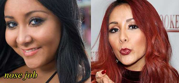 Snooki Plastic Surgery